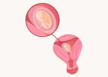 Ectopic Pregnancy