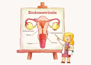 Endometriosis