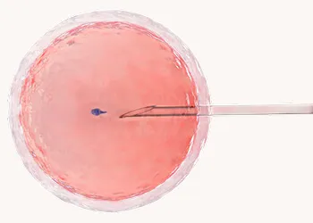 Intracytoplasmic Sperm Injection (ICSI)