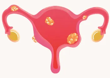 Uterine Fibroids
